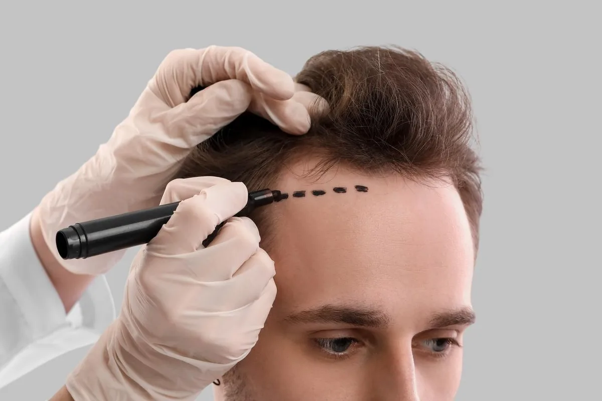 A gloved clinician marking a planned hairline on a patient's scalp.
