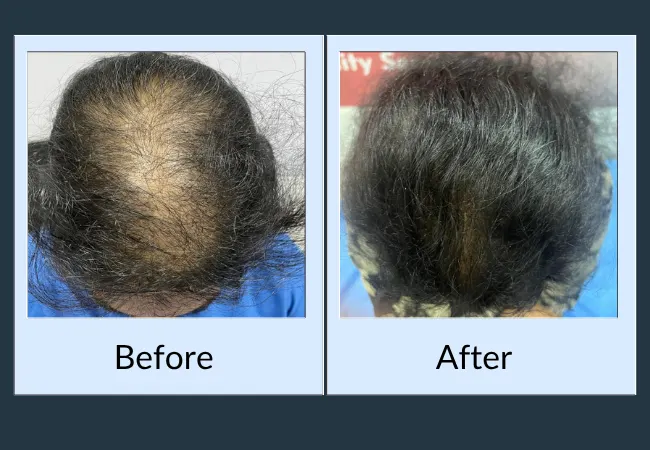 Female hair transplant before and after result