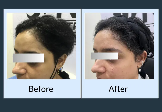 Female hair loss patient before and after hair restoration treatment
