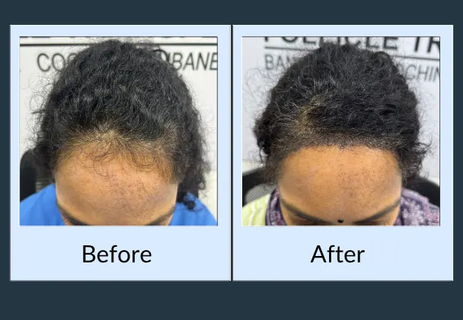 Widening part line before and after female hair loss treatment