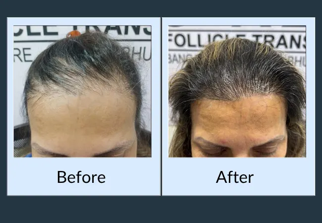 Female patient crown density before and after treatment