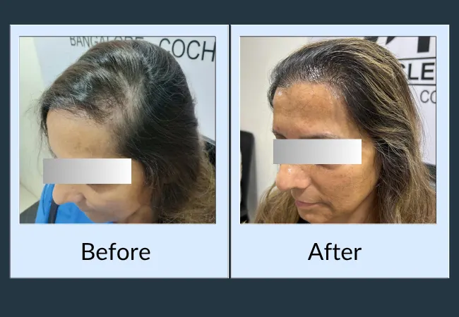 Female hairline restoration before and after result