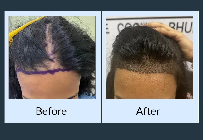 Diffuse female hair thinning before and after treatment