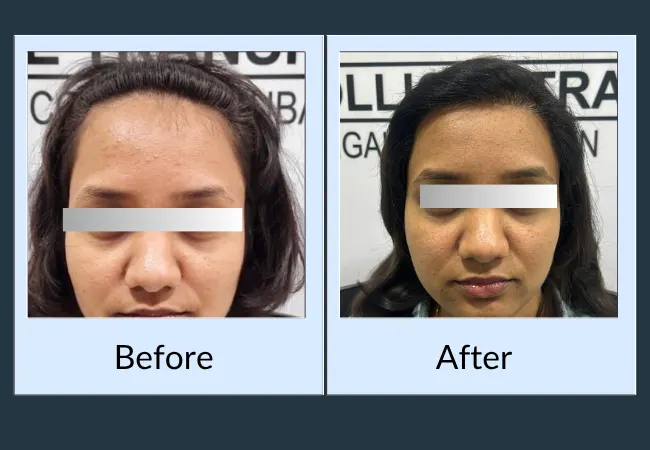 Female mid-scalp density before and after treatment