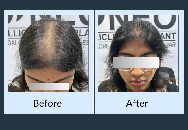 Female hair loss treatment result at the parting line