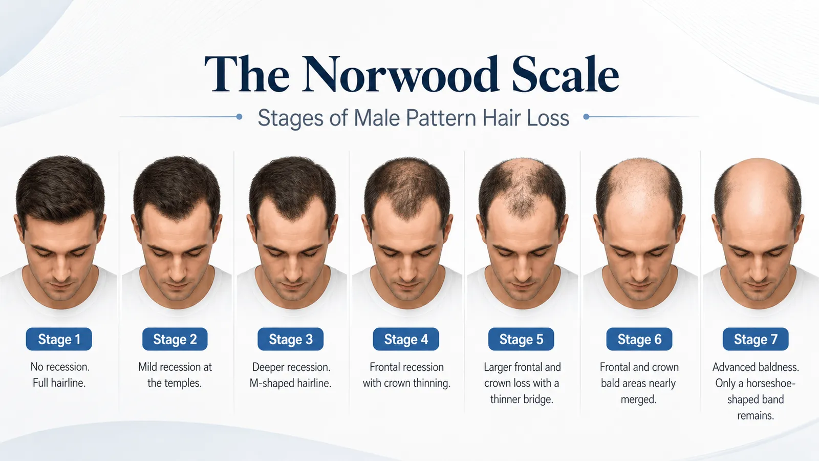 Norwood Scale Male Pattern Baldness