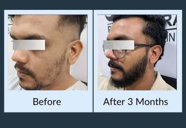 Beard transplant before and after three months: a patchy jawline with bare gaps along the cheek, then an even, connected beard.