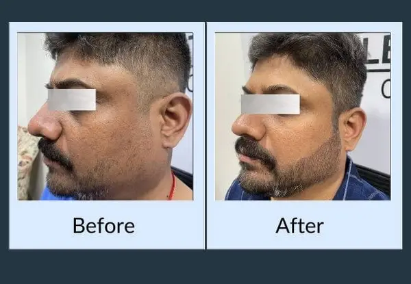 Beard transplant before and after: sparse growth over the cheek and jaw, then a denser beard with a defined cheek line.