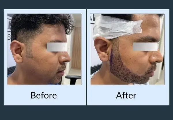 Beard transplant: a bare jawline before the procedure, then the same area immediately afterwards with the newly placed grafts still visible.