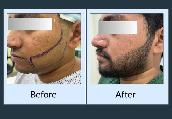 Beard transplant before and after: a jawline marked out for grafting, then a full beard following the planned outline.