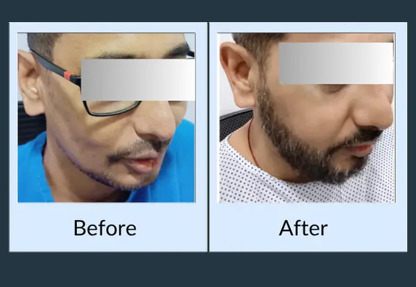 Beard transplant before and after: patchy growth with bare areas under the chin, then a dense, even beard.