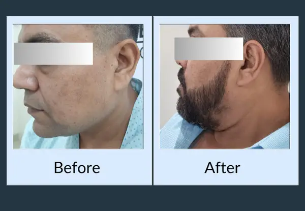Beard transplant before and after: an almost bare cheek and jaw, then thick beard coverage over the same area.
