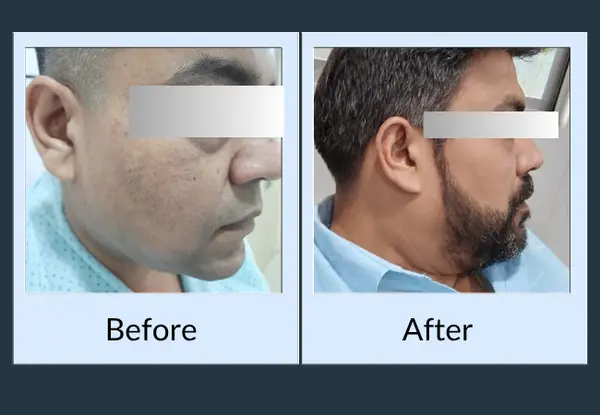 Beard transplant before and after: thin, uneven growth along the cheek, then a full beard with a clean cheek line.
