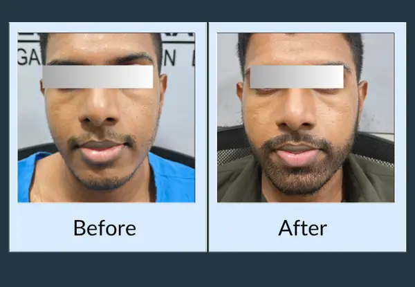 Beard transplant before and after, front view: a sparse moustache and patchy chin, then connected, even facial hair.