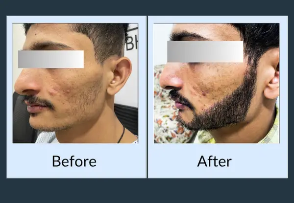 Beard transplant before and after in a younger patient: minimal growth on the cheek, then a dense, defined beard.