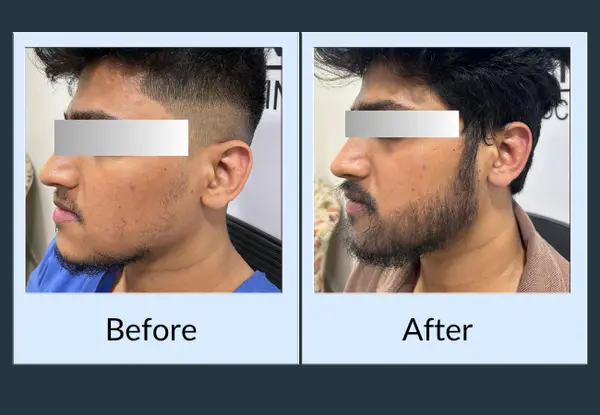 Beard transplant before and after: light, wispy growth along the jaw, then a thick beard with a straight cheek line.