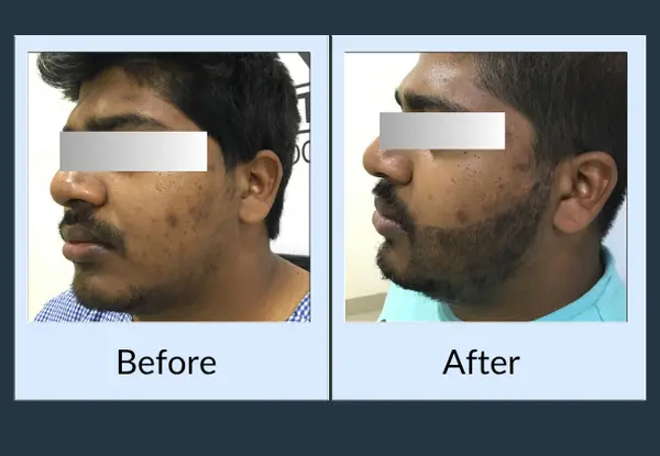 Beard transplant before and after: bare patches through the cheek and jaw, then continuous beard coverage.