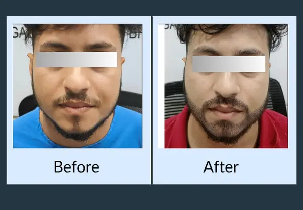 Beard transplant before and after, front view: a thin moustache and sparse chin, then a full, framed beard.