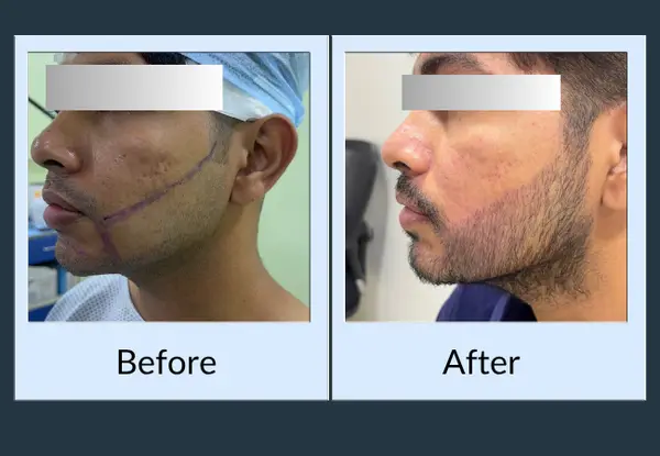 Beard transplant before and after: the jawline marked for grafting in theatre, then the grown-in beard along that line.