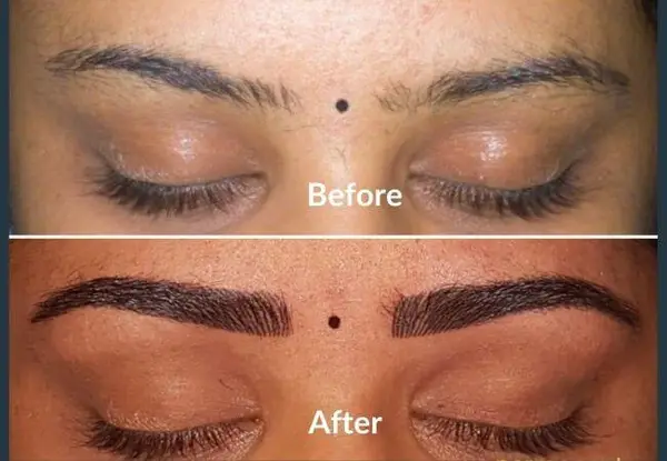 Eyebrow transplant before and after: thin, patchy brows with gaps through the body, then full, evenly shaped brows.