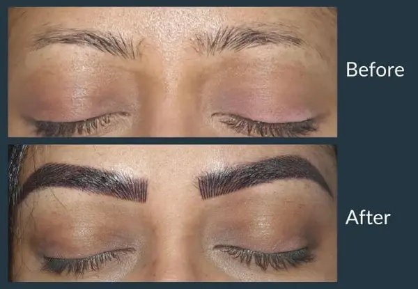 Eyebrow transplant before and after: sparse, faint brows, then dense, clearly defined brows with a natural arch.