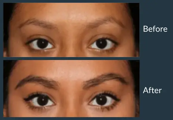 Eyebrow transplant before and after: thin, over-plucked brows tapering away at the outer ends, then full brows carried through to the tail.