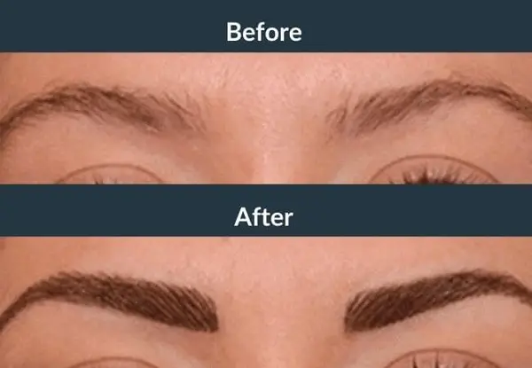 Eyebrow transplant before and after: light, wispy brows with little definition, then dark, thick brows with a defined outline.