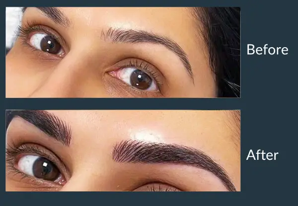 Eyebrow transplant before and after, close view of one brow: sparse hair along a thin brow line, then a full, shaped brow.