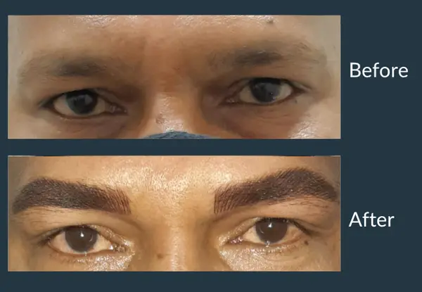 Eyebrow transplant before and after in a male patient: thin, sparse brows, then fuller brows with a defined upper edge.