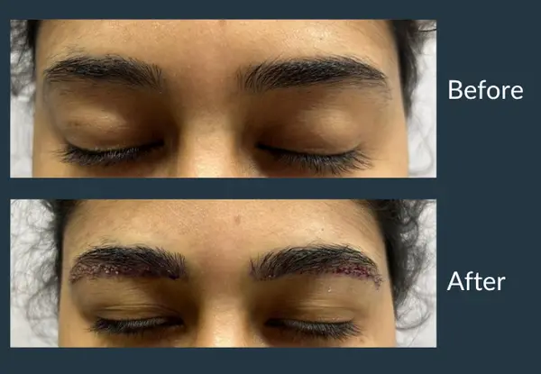 Eyebrow transplant: sparse brows before the procedure, then the same brows immediately afterwards with the newly placed grafts still visible.