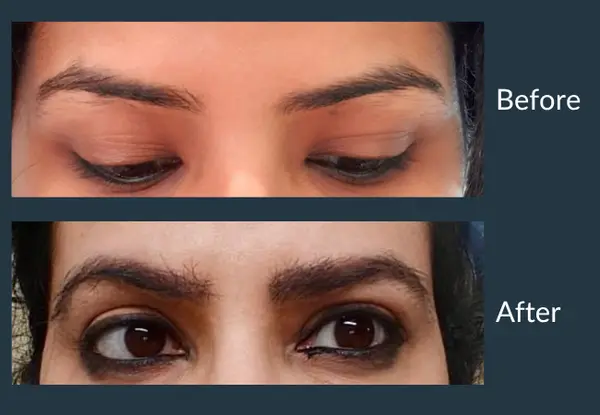 Eyebrow transplant before and after: a thin, sharply arched brow line, then full, softly shaped brows.