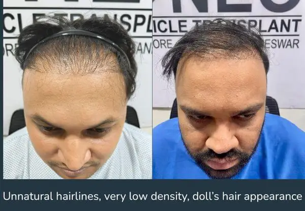 A hair transplant performed at another clinic, shown before corrective work: an unnatural hairline with very low density and a pluggy, doll-like appearance.