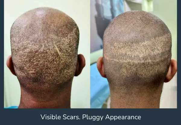 The back of the scalp after a hair transplant performed at another clinic, before corrective work: a band of visible donor-area scarring across the back of the head.