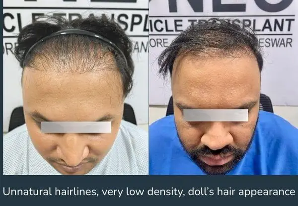 The same unnatural, low-density hairline from a transplant performed at another clinic, shown before corrective work.