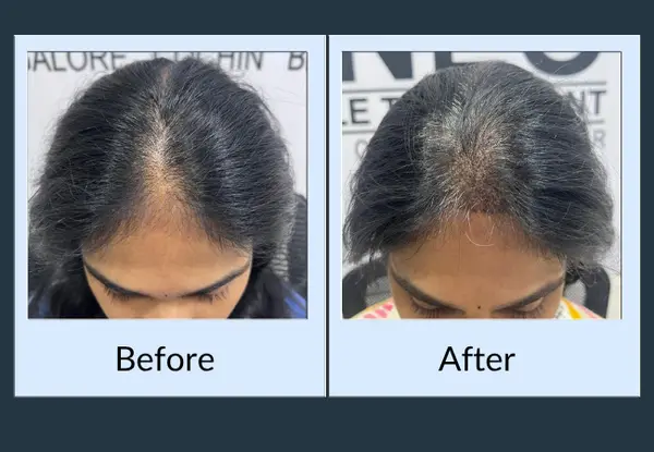 Female hair restoration before and after seen from above: a widening centre parting with visible scalp, then denser hair closing the parting.