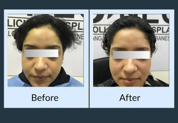 Female hair restoration before and after, front view: a sparse frontal hairline set high on the forehead, then a fuller, lower hairline.