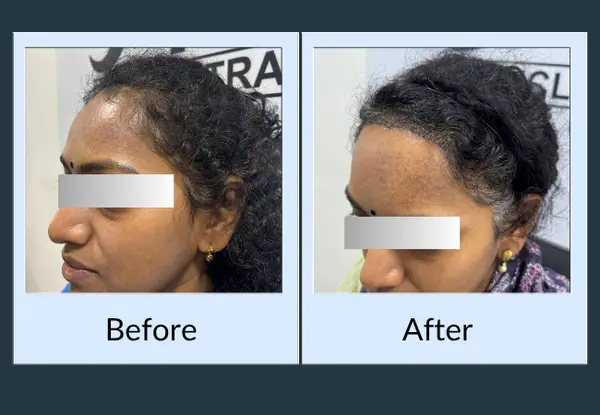 Female hair restoration before and after, profile view: a sparse temple and thin hairline, then fuller coverage framing the face.