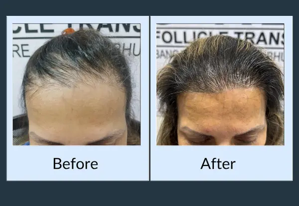 Female hair restoration before and after: a high hairline with fine, sparse hair at the front, then a lowered hairline with visible density.