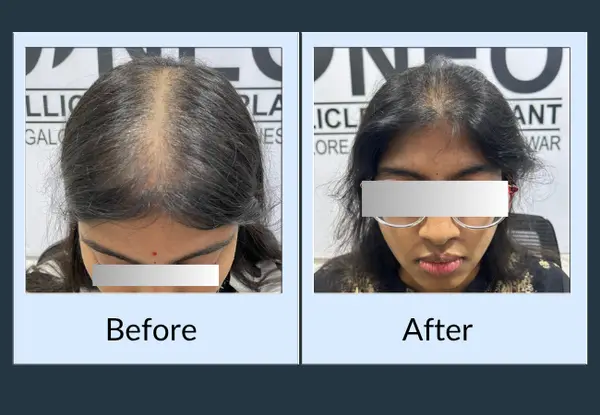 Female hair restoration before and after seen from above: a wide centre parting through thinning hair, then a narrower parting with denser hair either side.