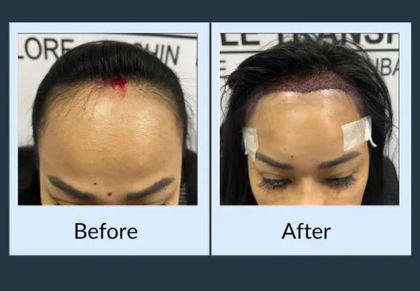 Female hairline restoration: a high hairline before the procedure, then the newly lowered hairline immediately afterwards, with the fresh incision line still visible.