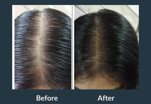 GFC therapy before and after seen from above: a wide centre parting with scalp showing through, then thicker hair narrowing the same parting.