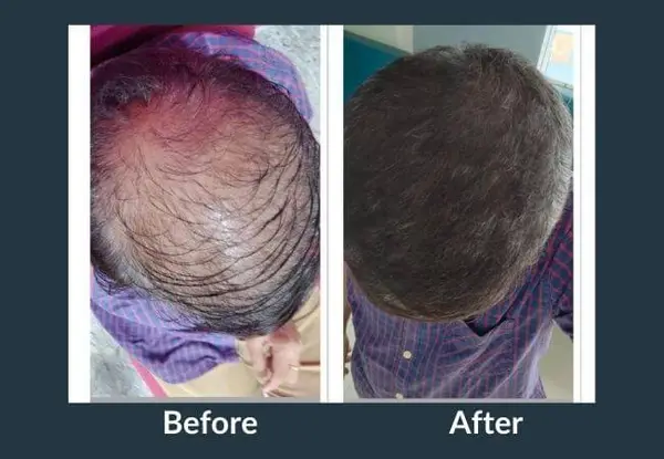 GFC therapy before and after seen from above: a thinning crown with the scalp visible, then fuller hair covering it.