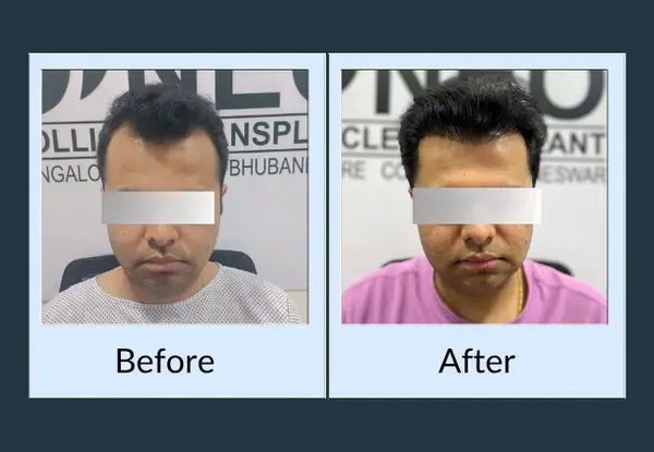 Hair transplant before and after: receding temples either side of a thin central tuft, then a squared-off hairline with density restored at both corners.