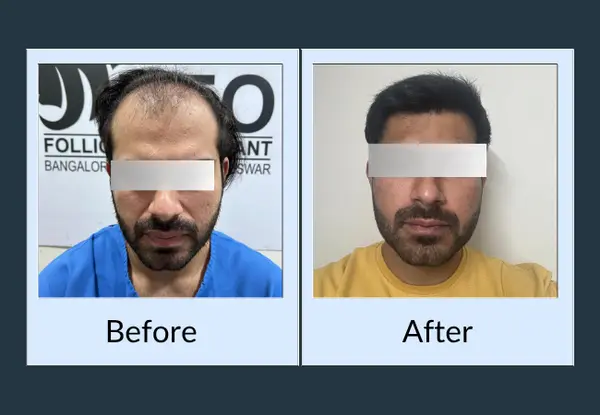 Hair transplant before and after: advanced frontal recession exposing the mid-scalp, then a straight, dense hairline.