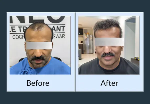 Hair transplant before and after: thinning across the front and crown, then restored coverage styled with a side parting.