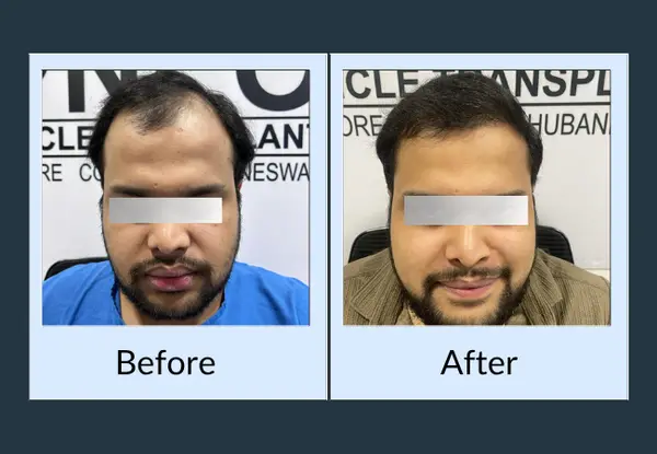 Hair transplant before and after: hair loss at both frontal corners, then a rebuilt hairline framing the forehead evenly.