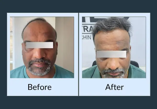 Hair transplant before and after in an older patient: a bald frontal scalp, then a restored grey hairline matching the surrounding hair.