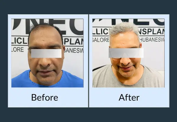 Hair transplant before and after in an older patient: frontal recession and a thin crown, then restored white-grey coverage.
