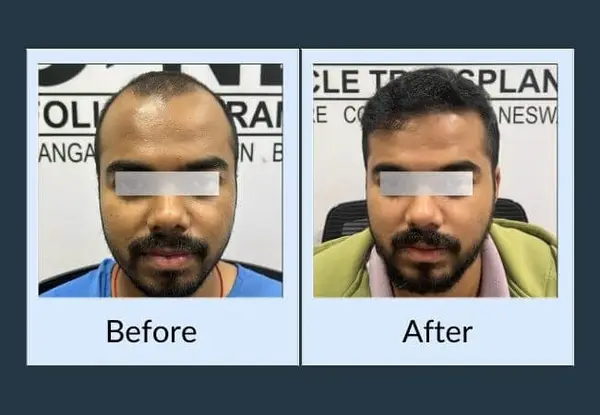 Hair transplant before and after: heavy recession at the temples and front, then a full hairline with natural temple points.