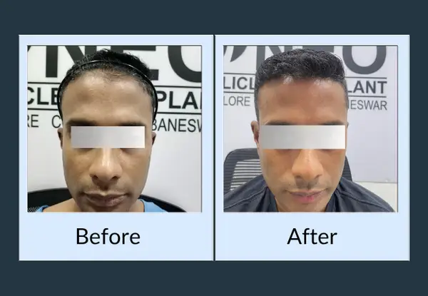 Hair transplant before and after viewed from above: a thin, see-through frontal scalp, then dense coverage over the same area.